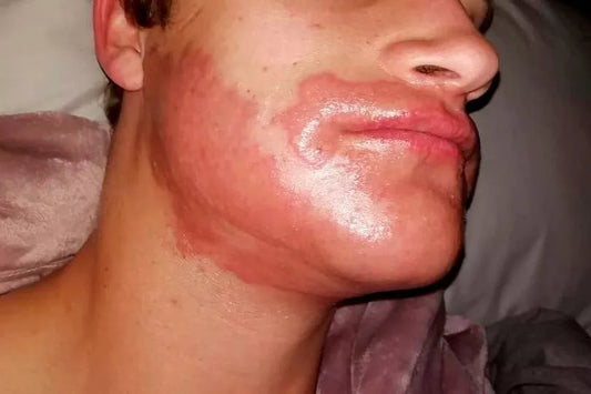 Beard Dye Allergic Reaction Contact dermatitis